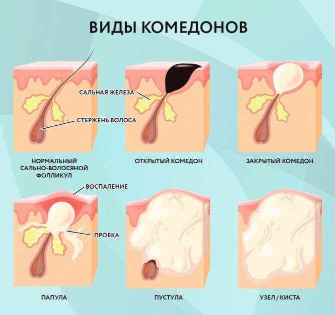 Виды Акне на Жирной Коже